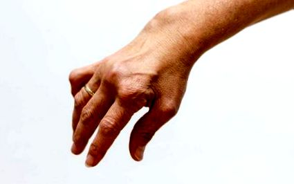 hogyan kell kezelni a kéz osteoarthritisét kenőcsök az ízületek osteochondrosisára