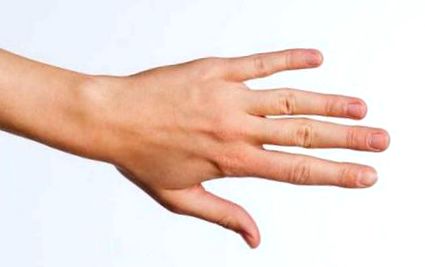 Ízületek ujjak fájdalma. Porckopás – Osteoarthrózis