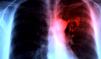 Súlycsökkenés a tuberkulózis után - Legjobb koktélok amikor fogyni próbál