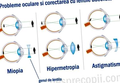 Hogyan gyógyítható a látás 3. Fejfájás a rossz látás miatt