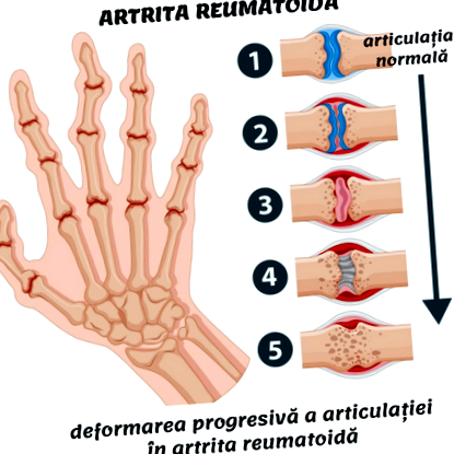 a csukló osteoarthritisének kezelése bokaízület artrózisa 1 fokos mi ez