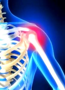 a térd deformáló artrózisának kezdeti jelei