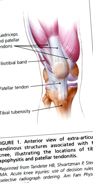 Emberi térdízületi fájdalom belülről, 2. Rheumatoid arthritis