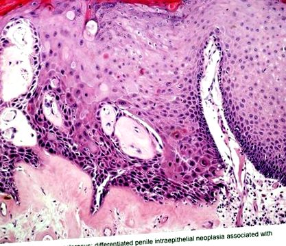 Orr papilloma patológia - Formációk típusai