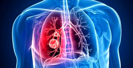 A tüdő megtisztult a dohányzásról való leszokáshoz szaponinok a dohányzás elleni küzdelemben