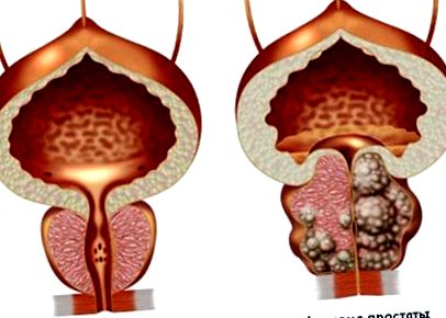 does low testosterone cause prostate problems adenoma centrale della prostata