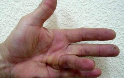 fájdalom az ujjak ízületeiben hajlításkor váll osteochondrosis