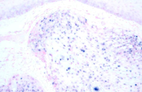 Cancerul glandei mamare ppt, Papilloma arcus palatopharyngeus
