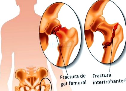 csípőízületi osteoarthritis kezelése 1 húzó lábak hátfájás