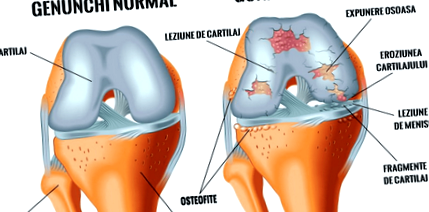 Reumatoid Artritis - Fájdalomközpont - Boka osteoarthritis műtéti kezelése