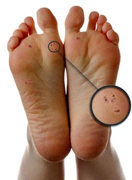 Paraziták a lábon, Rovarok és élősködők okozta bőrbetegségek