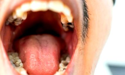 Uvula papilloma tünetei, A HPV fertőzöttség tünetei