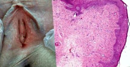 Vestibular papillomatosis compared to genital warts, Vestibular papillomatosis vs warts