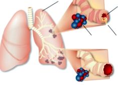 Biostimul biolamp asztma