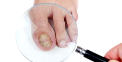 ciuperca unghiilor de la picioare cum să tratezi remediu