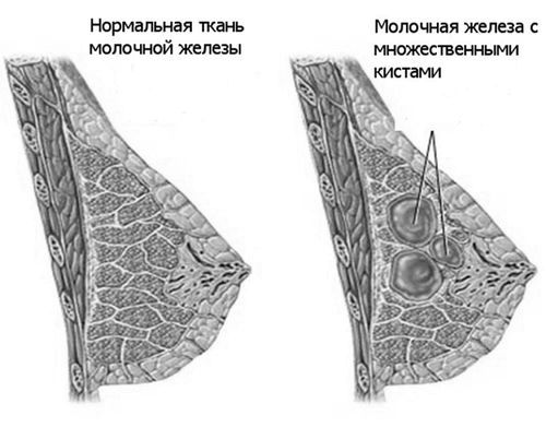 як лікувати аденоз мастопатію