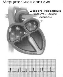 Аритмія серця: симптоми лікування народними засобами аритмія