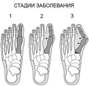 лікування