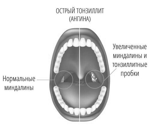 Чим лікувати ангіну при вагітності: небезпека тонзиліту в 1, 2 і 3 триместрах вагітності