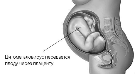 Чим небезпечний цитомегаловірус при вагітності і його лікування вагітності