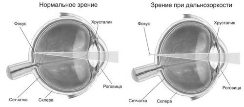 далекозорість