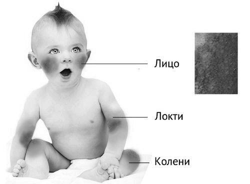 Діатез у дітей лікування - у немовляти, комаровский, народними засобами, мазь лікування