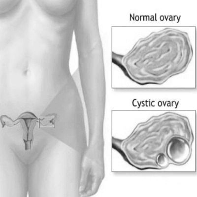 як лікувати двокамерну кісту яєчника