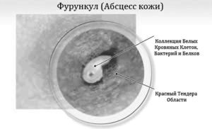 як лікувати фурункул на попі