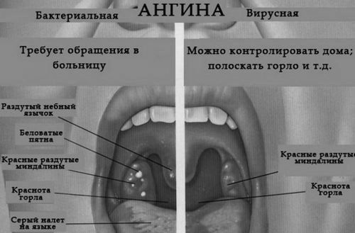 як вилікувати тонзиліт швидко