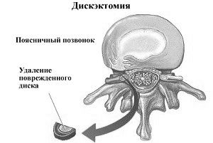 лікувати грижу спини