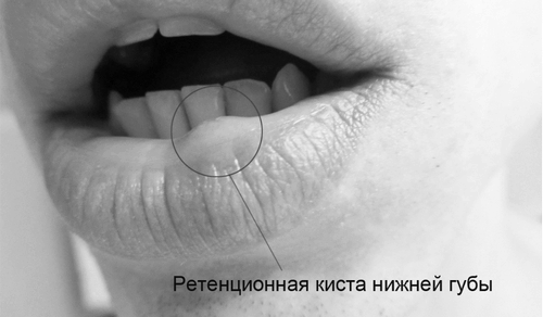 Кіста на губі: симптоми, причини, лікування, фото губі