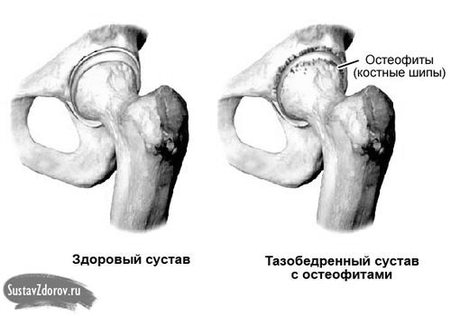 Коксартроз кульшового суглоба 2 ступеня: лікування, причини та симптоми суглоба