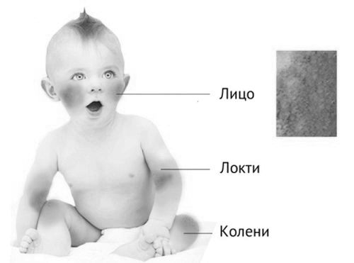 Контактний дерматит: фото, симптоми, лікування дерматит