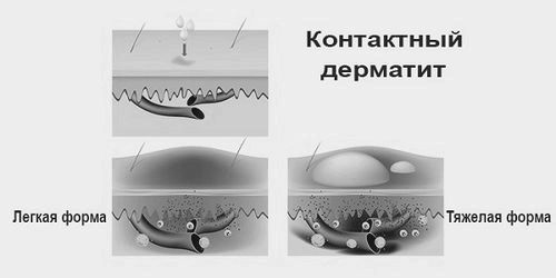 Контактний дерматит: фото, симптоми, лікування симптоми