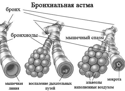 як лікувати задишку при астмі