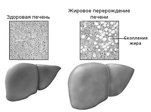 як вилікувати ожиріння печінки народними засобами