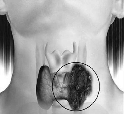 як лікувати рак щитовидної залози