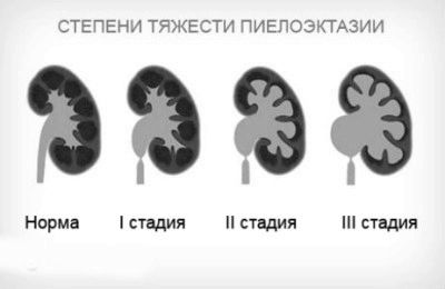 Ниркова балія: це що таке, чому розширена і як лікувати у дорослих як лікувати розширення нирки