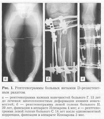 як лікувати рахіт грудної клітини