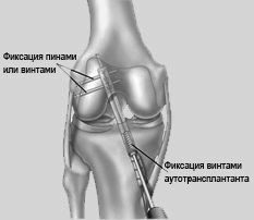 коліно