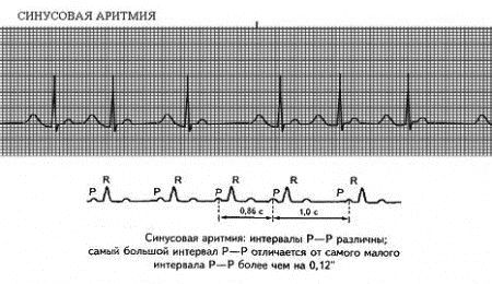 синусова аритмія серця чим небезпечна що це таке причини редставляет небезпеку для здоров'я в чому полягає небезпека відео
