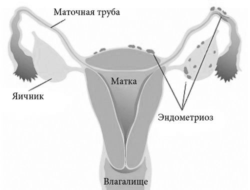 ендометріоз