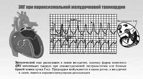 Тахікардія у дитини: симптоми і лікування, причини, перша допомога дитини