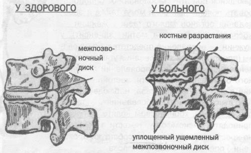 Хондроз шийного відділу хребта: симптоми і лікування хребта