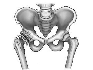 лікувати тазостегновий артроз