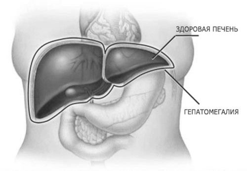гепатомегалия