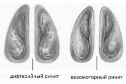 хронічний нежить що робити