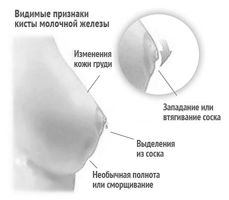 Кіста молочної залози: що це таке і як лікувати таке