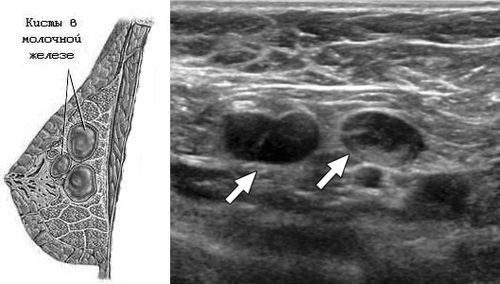 чи можна вилікувати кісту молочної залози