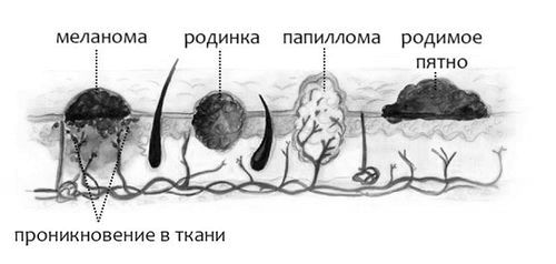 як лікувати папіломи на геніталіях в домашніх умовах